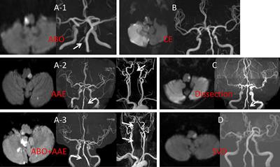 Risk Factors for Long-Term Death After Medullary Infarction: A Multicenter Follow-Up Study